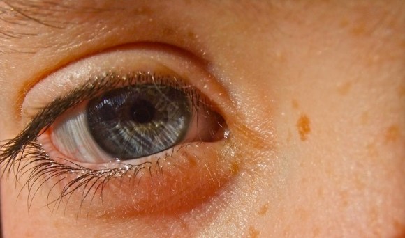 Joe's eye, 25/3/12